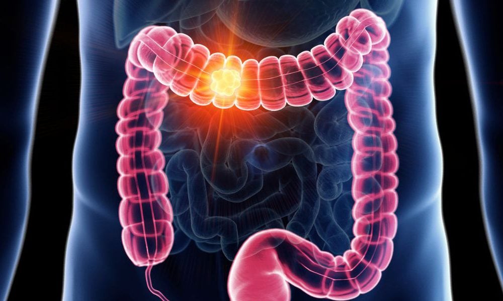 Indicate Colon Cancer